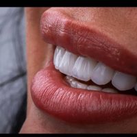 ایمپلنت/کامپوزیت/ دندانپزشکی / وام